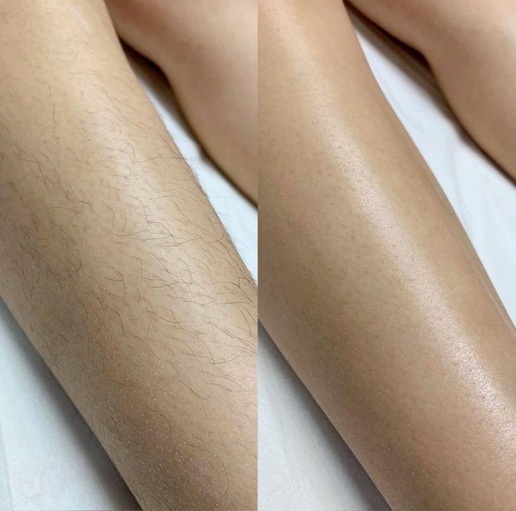 Depilación corporal de piernas con técnica suave